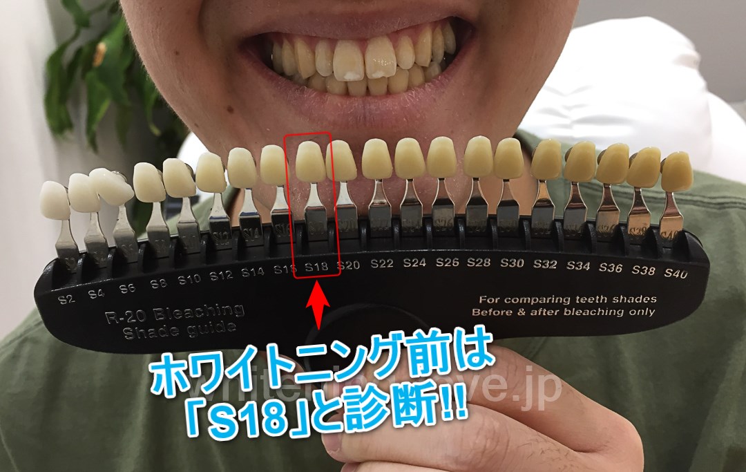 スターホワイトニングの歯のビフォー写真